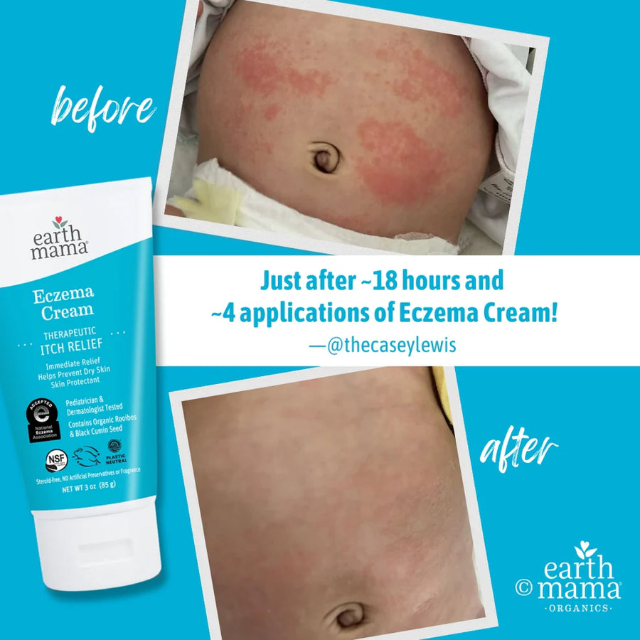 Steroid Free Eczema Cream